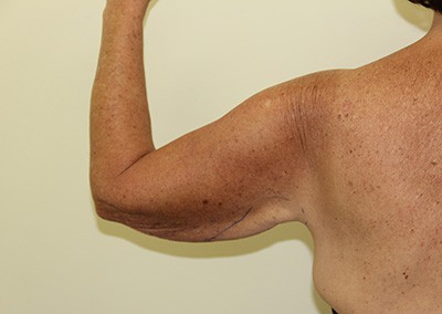 Before Image: Arm Lift - back