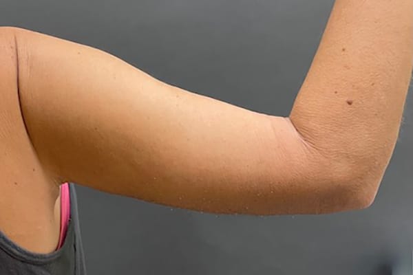 After Image: Arm Lift - back