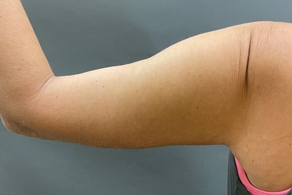 After Image: Arm Lift - back