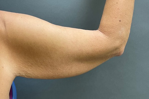 Before Image: Arm Lift - back