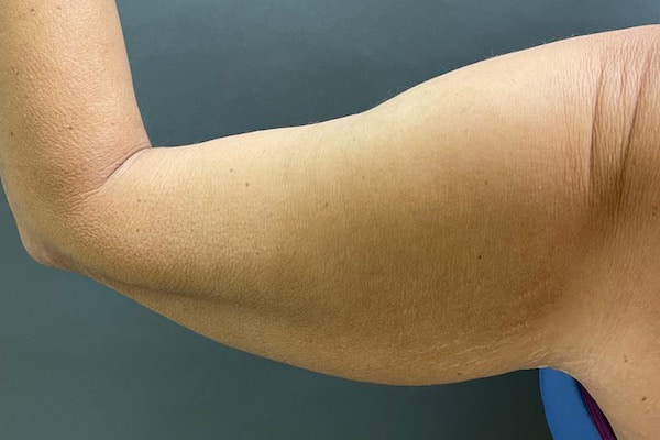 Before Image: Arm Lift - back