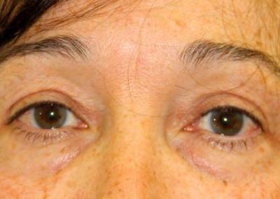 After Image: Blepharoplasty - front
