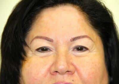 After Image: Blepharoplasty - front