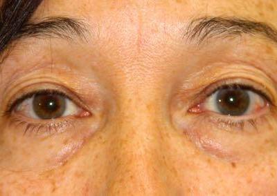 Before Image: Blepharoplasty - front