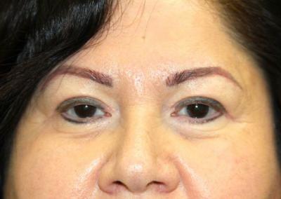 Before Image: Blepharoplasty - front
