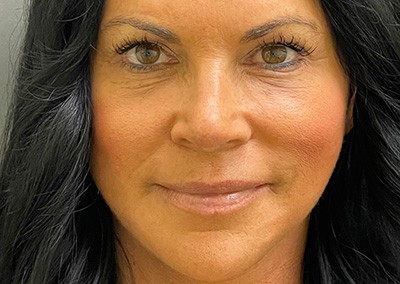 After Image: Blepharoplasty - front