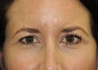Before Image: Blepharoplasty - front