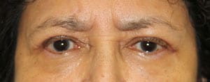 After Image: Blepharoplasty - front