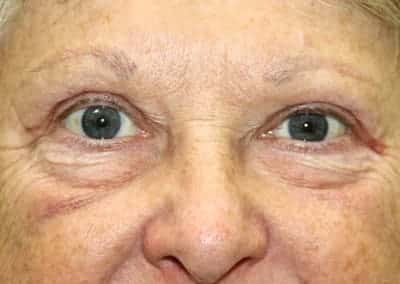 After Image: Blepharoplasty - front