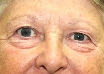 Before Image: Blepharoplasty - front