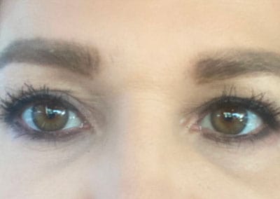 After Image: Blepharoplasty - front