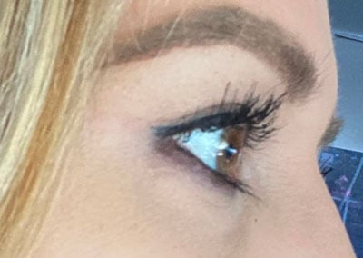 After Image: Blepharoplasty - right-front-oblique