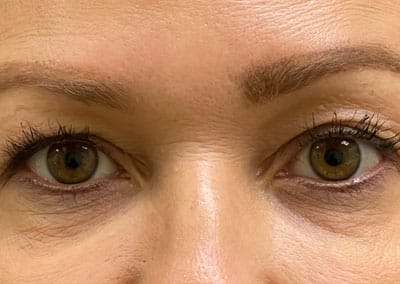 Before Image: Blepharoplasty - front