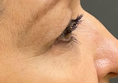 Before Image: Blepharoplasty - right-front-oblique