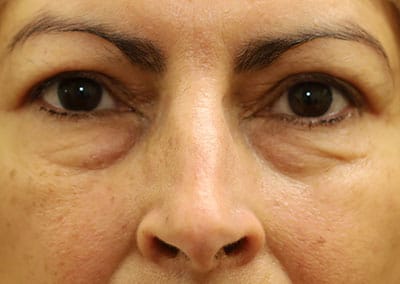 After Image: Blepharoplasty - front