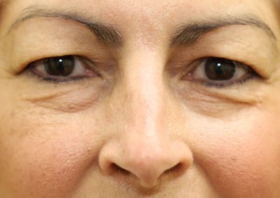 Before Image: Blepharoplasty - front