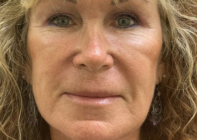 After Image: Blepharoplasty - front