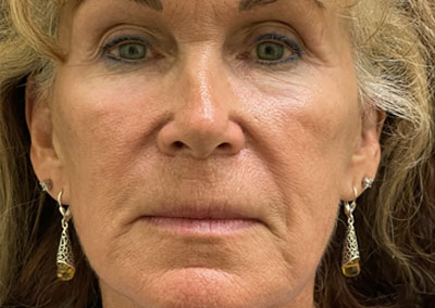 Before Image: Blepharoplasty - front