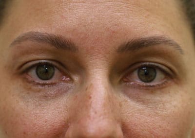 After Image: Blepharoplasty - front