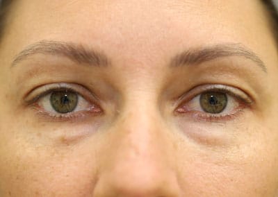 Before Image: Blepharoplasty - front