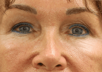 After Image: Blepharoplasty - front