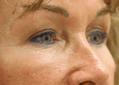 After Image: Blepharoplasty - front