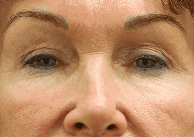 Before Image: Blepharoplasty - front