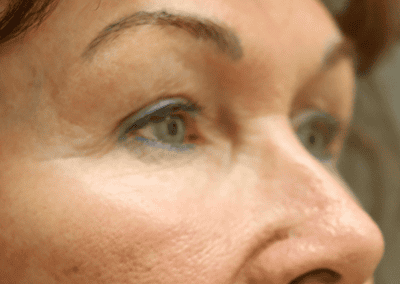 Before Image: Blepharoplasty - front