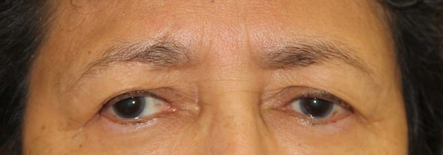Before Image: Blepharoplasty - front