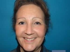 After Image: Blepharoplasty - front