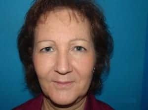 Before Image: Blepharoplasty - front