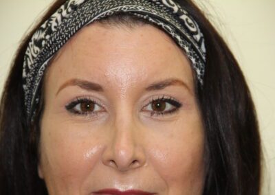 After Image: Blepharoplasty - front