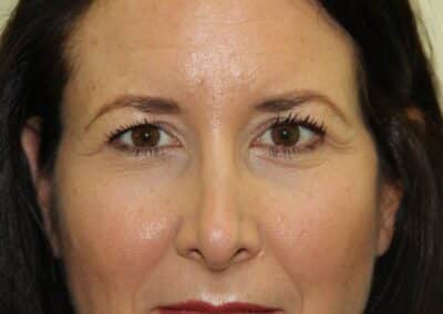 Before Image: Blepharoplasty - front