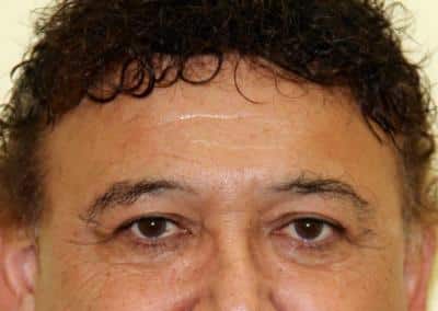 After Image: Blepharoplasty - front