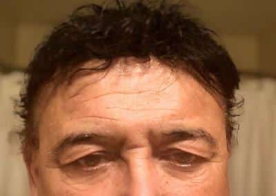 Before Image: Blepharoplasty - front