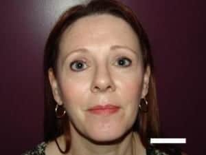 After Image: Blepharoplasty - front