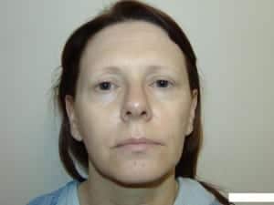 Before Image: Blepharoplasty - front