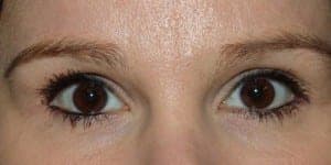 After Image: Blepharoplasty - front
