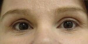 Before Image: Blepharoplasty - front