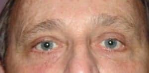 After Image: Blepharoplasty - front