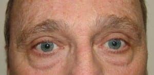 Before Image: Blepharoplasty - front