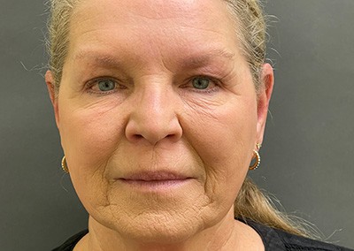 Before Image: Blepharoplasty - front
