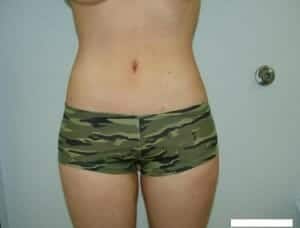 After Image: Body Contouring - front