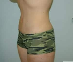 After Image: Body Contouring - left-front-oblique