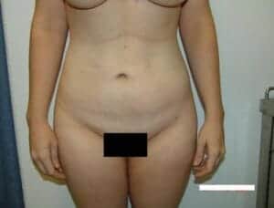 Before Image: Body Contouring - front