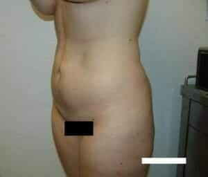 Before Image: Body Contouring - left-front-oblique