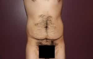 Before Image: Body Contouring - front