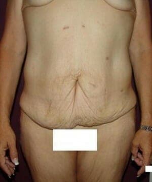 Before Image: Body Contouring - front