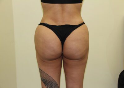 After Image: Brazilian Butt Lift - back