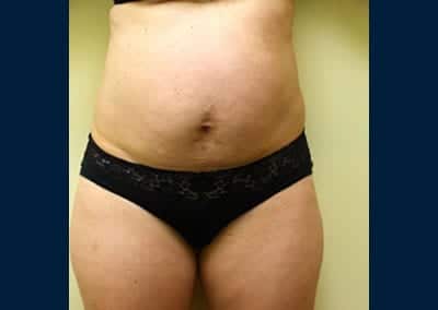Before Image: Brazilian Butt Lift - front